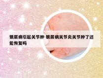 银屑病引起关节肿 银屑病关节炎关节肿了还能恢复吗