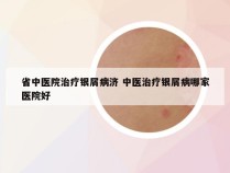 省中医院治疗银屑病济 中医治疗银屑病哪家医院好