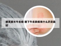 腋窝里长牛皮癣 腋下牛皮肤癣用什么药膏最好