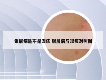 银屑病是不是湿疹 银屑病与湿疹对照图