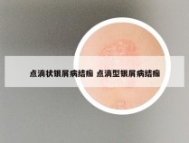 点滴状银屑病结痂 点滴型银屑病结痂