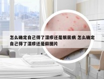 怎么确定自己得了湿疹还是银屑病 怎么确定自己得了湿疹还是藓图片