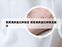 银屑病表面红肿脱皮 银屑病表面红肿脱皮图片