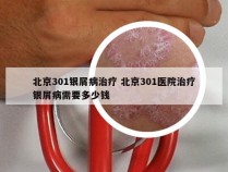 北京301银屑病治疗 北京301医院治疗银屑病需要多少钱