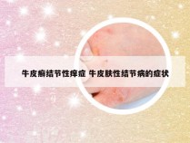 牛皮癣结节性痒症 牛皮肤性结节病的症状