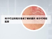 蚊子叮过的地方变成了癣的图片 蚊子叮咬后起藓