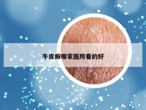 牛皮癣哪家医院看的好