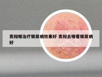 贵阳哪治疗银屑病效果好 贵阳去哪看银屑病好