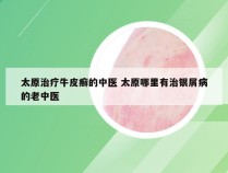 太原治疗牛皮癣的中医 太原哪里有治银屑病的老中医