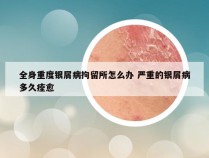 全身重度银屑病拘留所怎么办 严重的银屑病多久痊愈