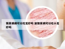 银屑病病可以吃龙虾吗 副银屑病可以吃小龙虾吗