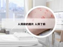 人得藓的图片 人得了癣
