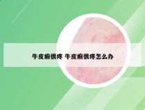 牛皮癣很疼 牛皮癣很疼怎么办