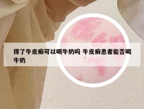 得了牛皮癣可以喝牛奶吗 牛皮癣患者能否喝牛奶
