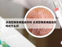 点滴型银屑病是血热吗 点滴型银屑病是血热吗吃什么药