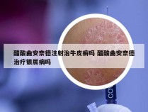 醋酸曲安奈德注射治牛皮癣吗 醋酸曲安奈德治疗银屑病吗