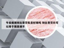 牛皮癣用特比萘芬乳膏好用吗 特比萘芬片可以用于银屑病不