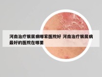 河南治疗银屑病哪家医院好 河南治疗银屑病最好的医院在哪里