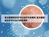 复方酮康唑软膏可以治疗牛皮癣吗 复方酮康唑软膏可以治疗银屑病吗