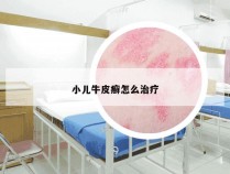 小儿牛皮癣怎么治疗