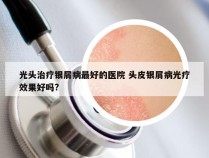 光头治疗银屑病最好的医院 头皮银屑病光疗效果好吗?