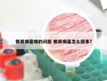 银屑病是哪的问题 银屑病是怎么回事?