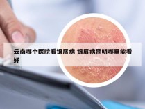 云南哪个医院看银屑病 银屑病昆明哪里能看好