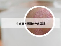 牛皮癣与真菌有什么区别