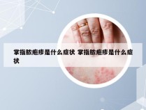 掌指脓疱疹是什么症状 掌指脓疱疹是什么症状