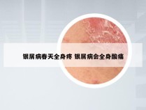 银屑病春天全身疼 银屑病会全身酸痛