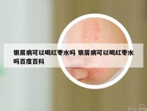 银屑病可以喝红枣水吗 银屑病可以喝红枣水吗百度百科