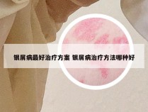 银屑病最好治疗方案 银屑病治疗方法哪种好