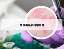 牛皮癣最新科学研究
