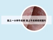 腿上一小块牛皮癣 腿上牛皮癣症状图片