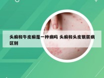 头癣和牛皮癣是一种病吗 头癣和头皮银屑病区别