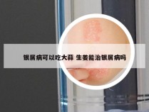 银屑病可以吃大蒜 生姜能治银屑病吗