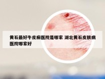 黄石最好牛皮癣医院是哪家 湖北黄石皮肤病医院哪家好