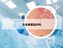 牛皮癣熏能好吗