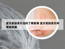 复方氨肽素片治好了银屑病 复方氨肽素片和银屑胶囊