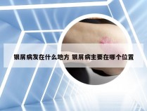 银屑病发在什么地方 银屑病主要在哪个位置
