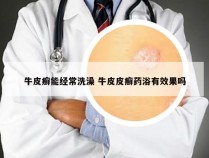 牛皮癣能经常洗澡 牛皮皮癣药浴有效果吗