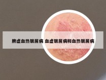 脾虚血热银屑病 血虚银屑病和血热银屑病