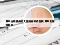 深圳治银屑病的大医院有哪些医院 深圳去除银屑病