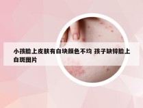 小孩脸上皮肤有白块颜色不均 孩子缺锌脸上白斑图片