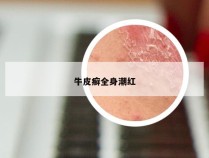 牛皮癣全身潮红