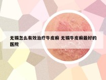 无锡怎么有效治疗牛皮癣 无锡牛皮癣最好的医院