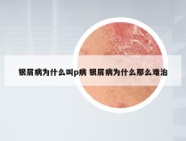 银屑病为什么叫p病 银屑病为什么那么难治