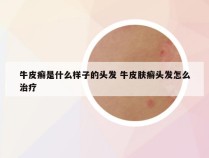牛皮癣是什么样子的头发 牛皮肤癣头发怎么治疗