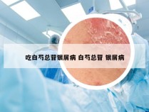 吃白芍总苷银屑病 白芍总苷 银屑病