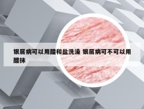 银屑病可以用醋和盐洗澡 银屑病可不可以用醋抹